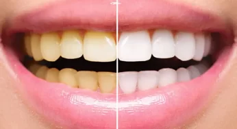Pemutihan Gigi (Dental Bleaching): Apa yang Perlu Anda Ketahui?