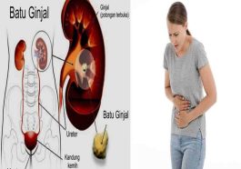 Kenali Penyebab Batu Ginjal: Gejala Awal, Reaksi Tubuh Hingga Obat yang Dikonsumsi