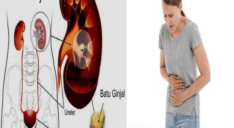 Kenali Penyebab Batu Ginjal: Gejala Awal, Reaksi Tubuh Hingga Obat yang Dikonsumsi