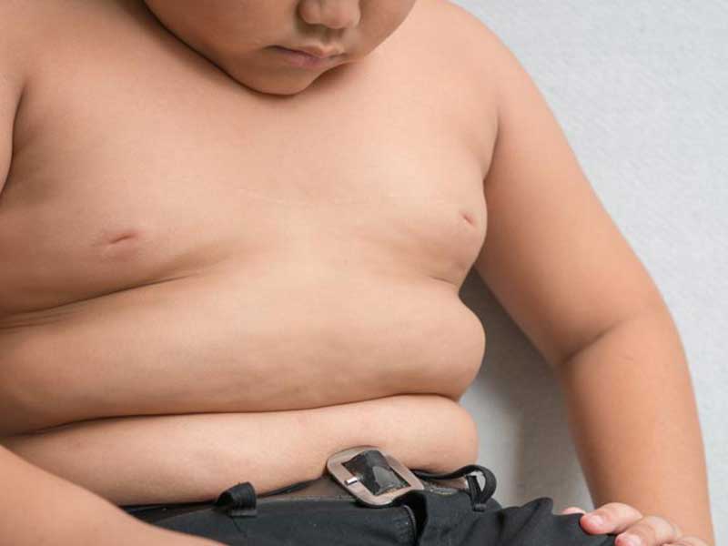Obesitas anak