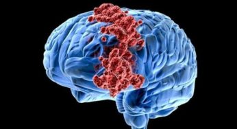 Gejala Awal Tumor Otak yang Kerap Diabaikan Tak Melulu Sakit Kepala